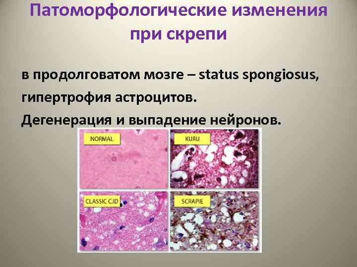 Патоморфологические изменения при скрепи в продолговатом мозге – status spongiosus, гипертрофия астроцитов. Дегенерация и