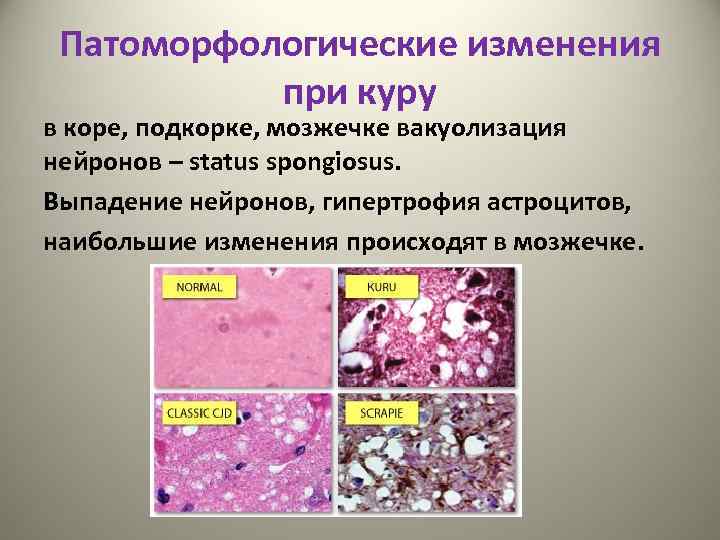 Патоморфологические изменения при куру в коре, подкорке, мозжечке вакуолизация нейронов – status spongiosus. Выпадение