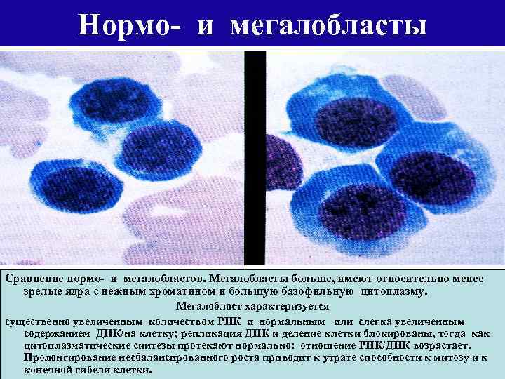 Нормо- и мегалобласты Сравнение нормо- и мегалобластов. Мегалобласты больше, имеют относительно менее зрелые ядра