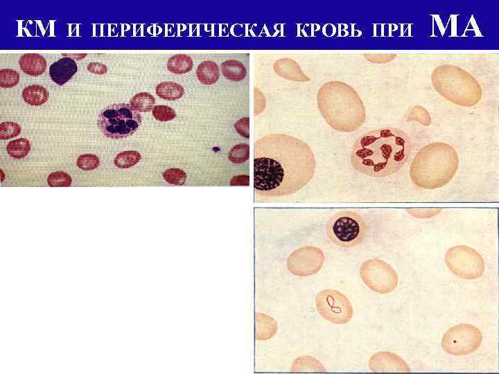 КМ И ПЕРИФЕРИЧЕСКАЯ КРОВЬ ПРИ МА 