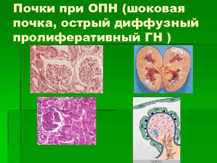Почки при ОПН (шоковая почка, острый диффузный пролиферативный ГН ) 