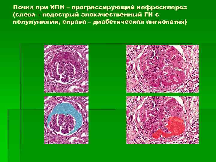 Почка при ХПН – прогрессирующий нефросклероз (слева – подострый злокачественный ГН с полулуниями, справа