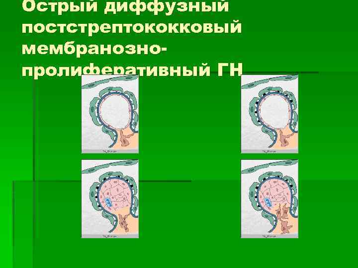 Острый диффузный постстрептококковый мембранознопролиферативный ГН 