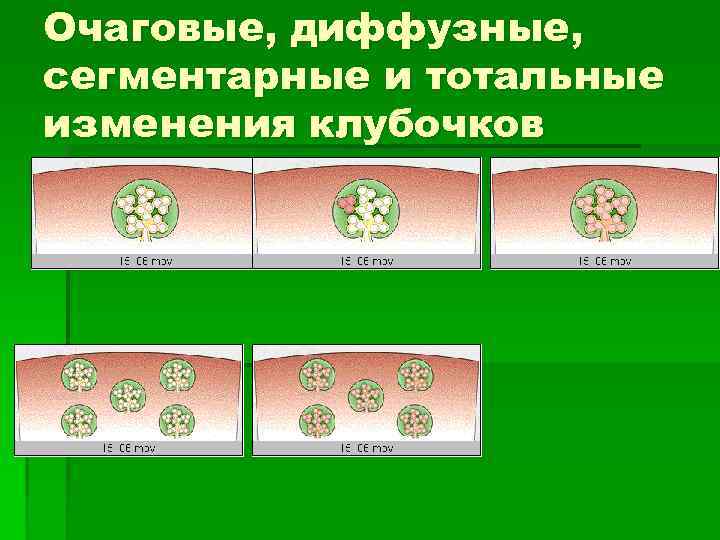 Очаговые, диффузные, сегментарные и тотальные изменения клубочков 