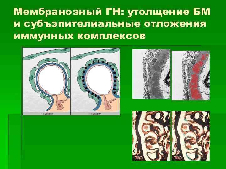 Мембранозный ГН: утолщение БМ и субъэпителиальные отложения иммунных комплексов 