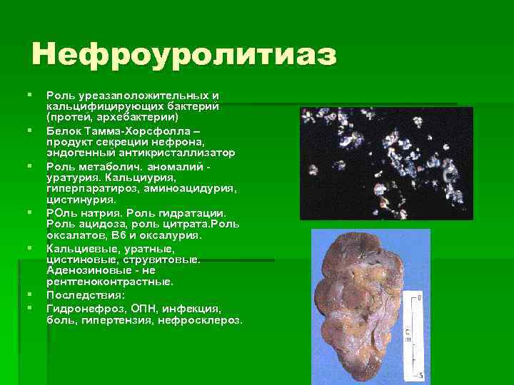 Нефроуролитиаз § § § § Роль уреазаположительных и кальцифицирующих бактерий (протей, архебактерии) Белок Тамма-Хорсфолла