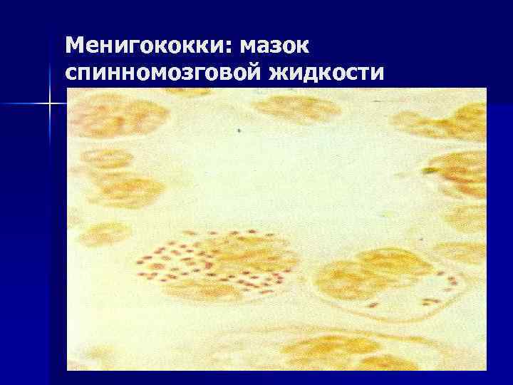 Менигококки: мазок спинномозговой жидкости 