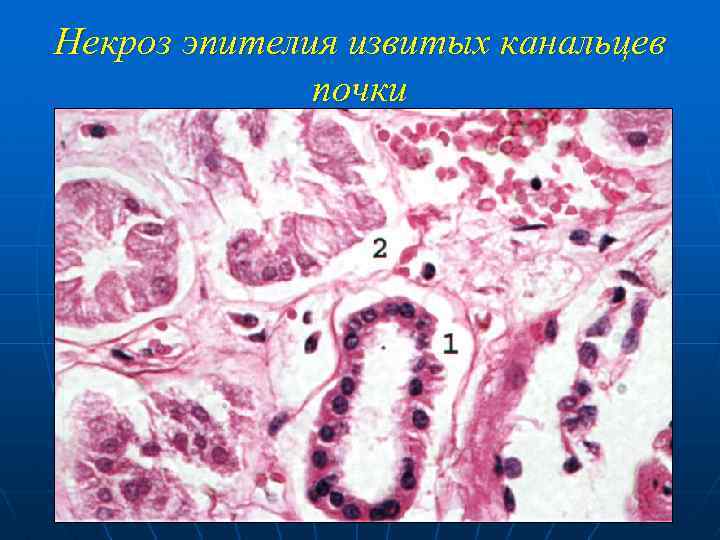 Некроз эпителия извитых канальцев почки 