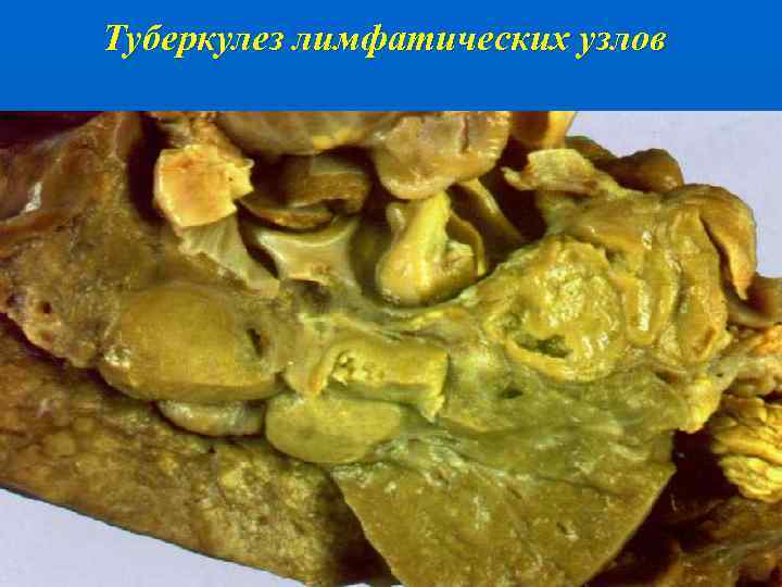 Туберкулез лимфатических узлов 