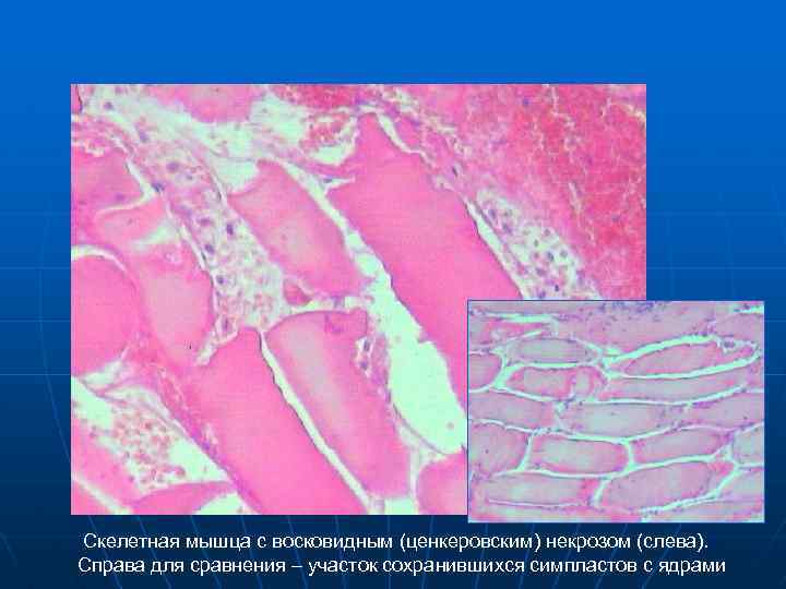Скелетная мышца с восковидным (ценкеровским) некрозом (слева). Справа для сравнения – участок сохранившихся симпластов