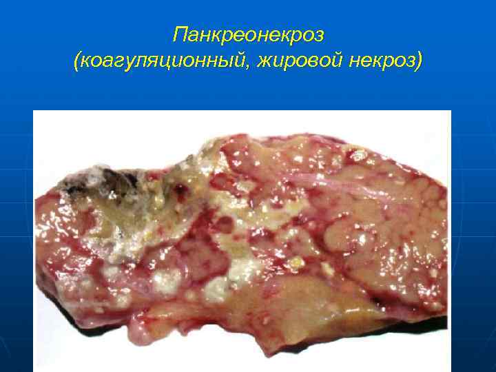 Панкреонекроз (коагуляционный, жировой некроз) 