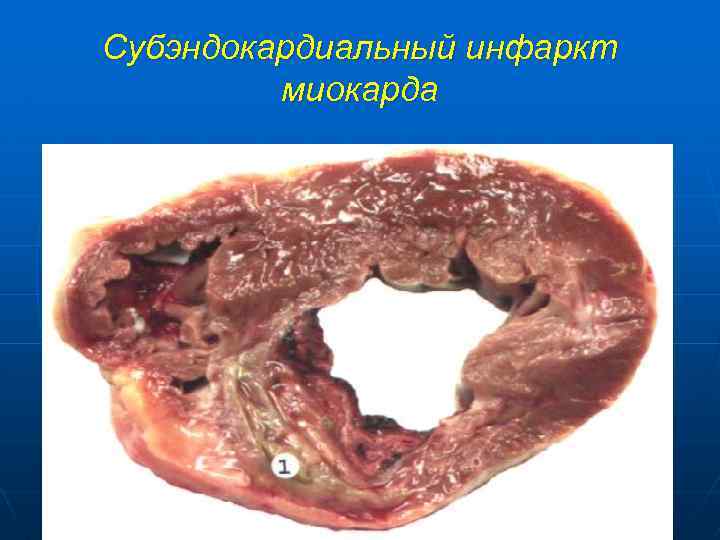 Субэндокардиальный инфаркт миокарда 