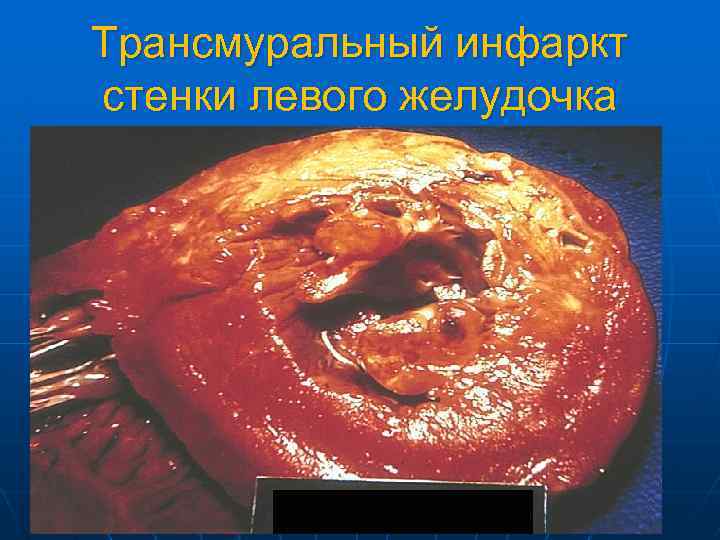 Трансмуральный инфаркт стенки левого желудочка 