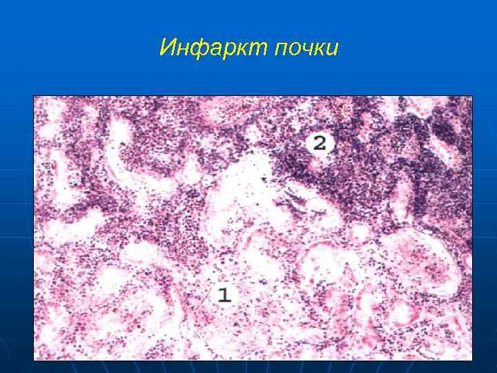 Инфаркт почки 