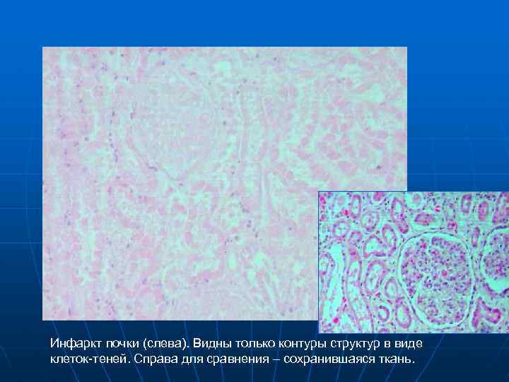 Инфаркт почки (слева). Видны только контуры структур в виде клеток-теней. Справа для сравнения –