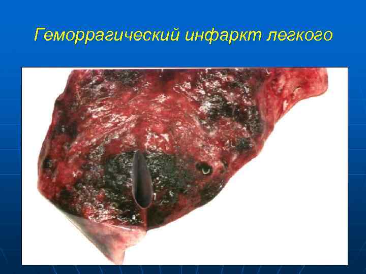 Геморрагический инфаркт легкого 