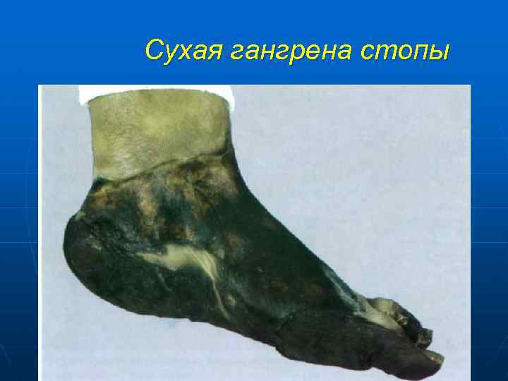 Сухая гангрена стопы 