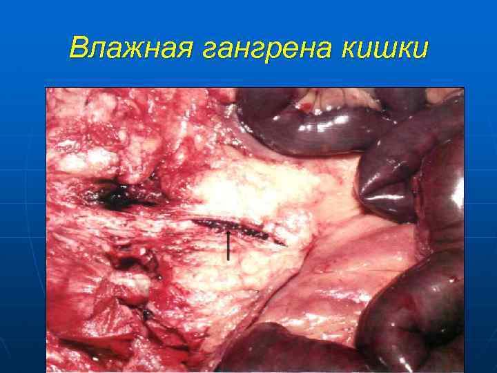 Влажная гангрена кишки 