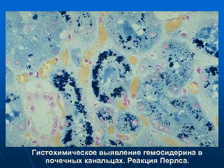 Гистохимическое выявление гемосидерина в почечных канальцах. Реакция Перлса. 