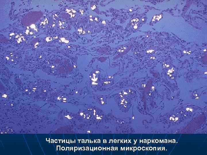 Частицы талька в легких у наркомана. Поляризационная микроскопия. 