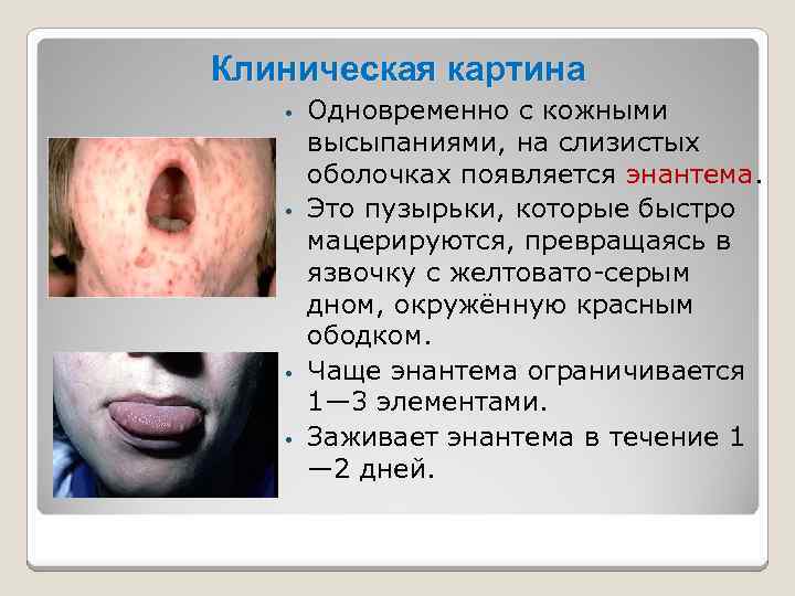 Клиническая картина Одновременно с кожными высыпаниями, на слизистых оболочках появляется энантема. • Это пузырьки,