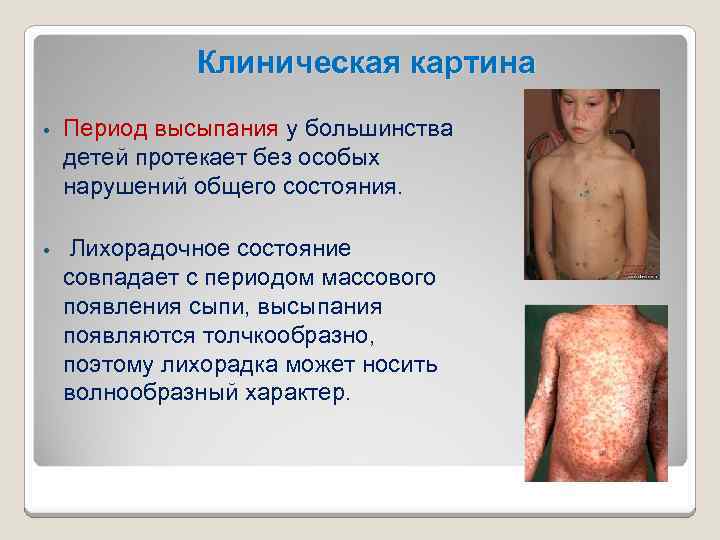 Клиническая картина • Период высыпания у большинства детей протекает без особых нарушений общего состояния.