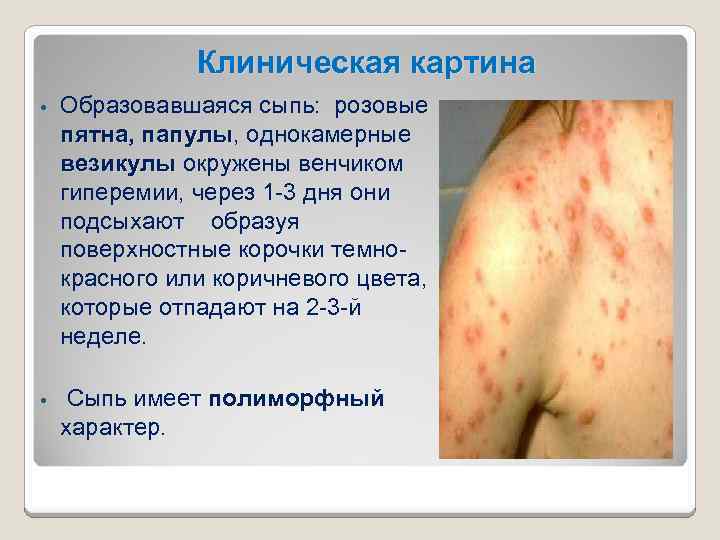 Клиническая картина • Образовавшаяся сыпь: розовые пятна, папулы, однокамерные папулы везикулы окружены венчиком везикулы