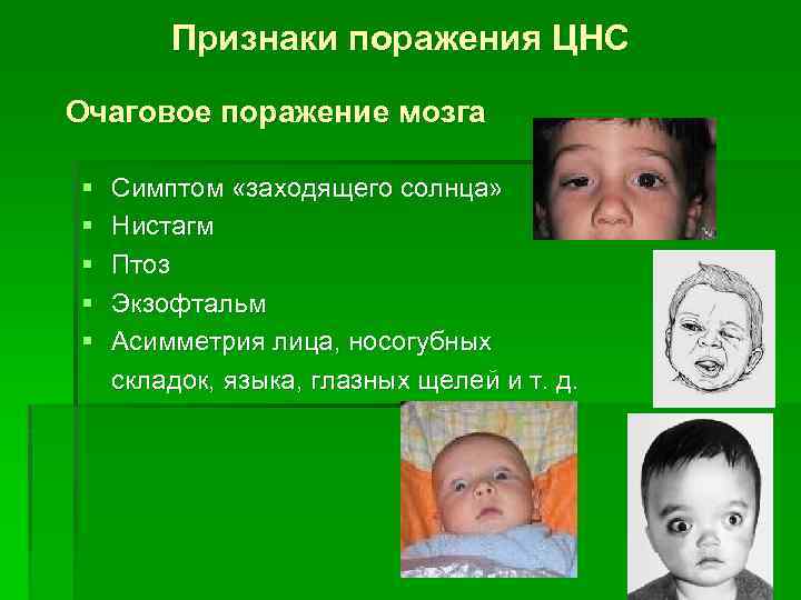 Признаки поражения ЦНС Очаговое поражение мозга § § § Симптом «заходящего солнца» Нистагм Птоз