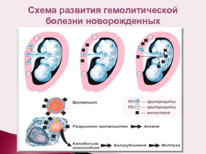 Схема развития гемолитической болезни новорожденных 