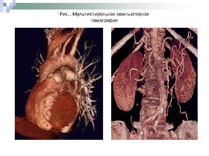 Рис. . Мультиспиральная компьютерная томография 