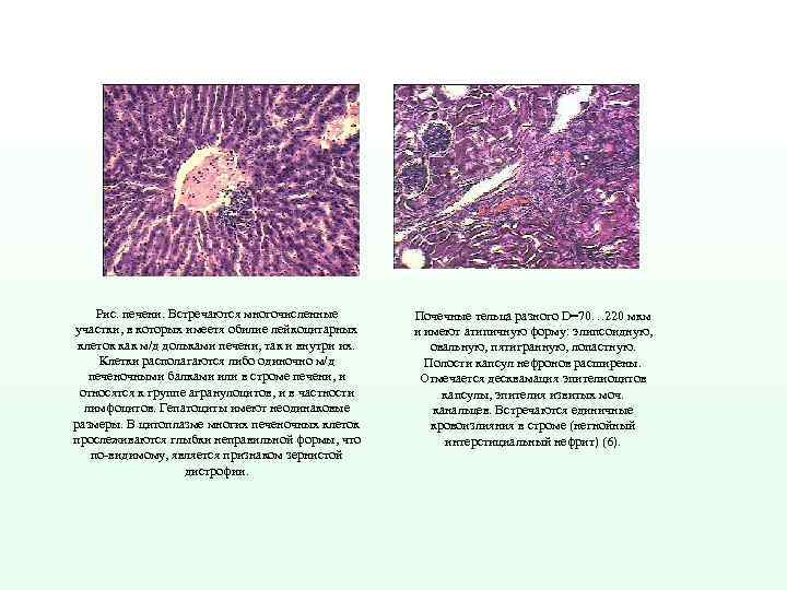 Рис. печени. Встречаются многочисленные участки, в которых имеетя обилие лейкоцитарных клеток как м/д дольками
