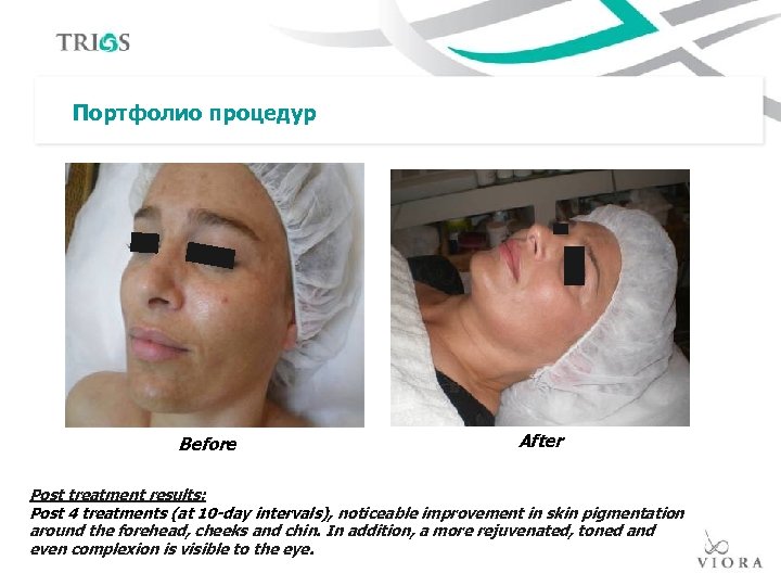 Портфолио процедур Before After Post treatment results: Post 4 treatments (at 10 -day intervals),