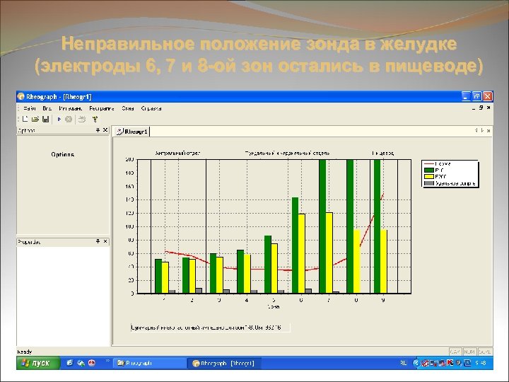 Неправильное положение зонда в желудке (электроды 6, 7 и 8 -ой зон остались в