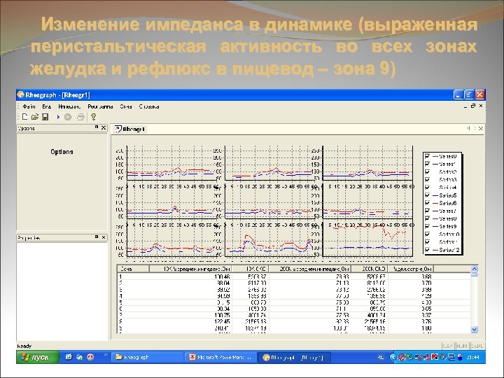 Изменение импеданса в динамике (выраженная перистальтическая активность во всех зонах желудка и рефлюкс в