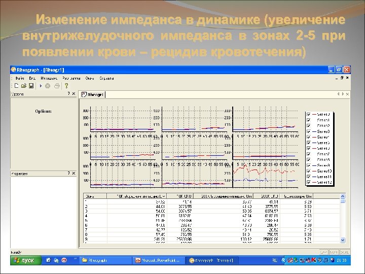 Изменение импеданса в динамике (увеличение внутрижелудочного импеданса в зонах 2 -5 при появлении крови
