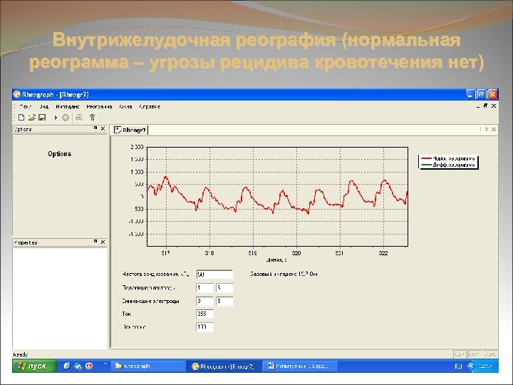 Внутрижелудочная реография (нормальная реограмма – угрозы рецидива кровотечения нет) 