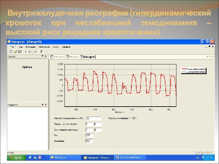 Внутрижелудочная реография (гипердинамический кровоток при нестабильной гемодинамике – высокий риск рецидива кровотечения) 