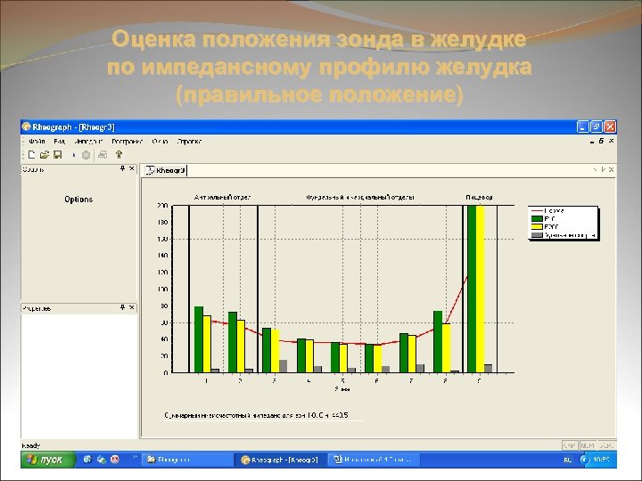 Оценка положения зонда в желудке по импедансному профилю желудка (правильное положение) 