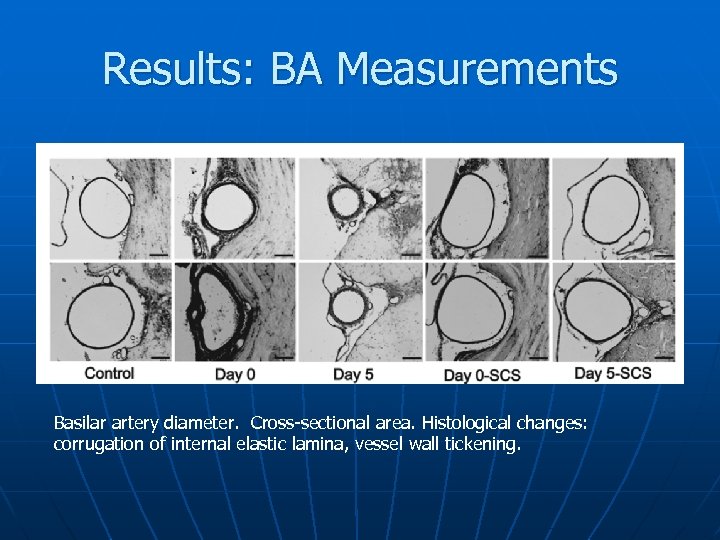 Results: BA Measurements Basilar artery diameter. Cross-sectional area. Histological changes: corrugation of internal elastic