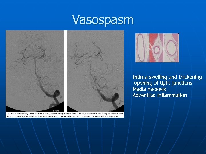 Vasospasm Intima swelling and thickening opening of tight junctions Media necrosis Adventita: inflammation 