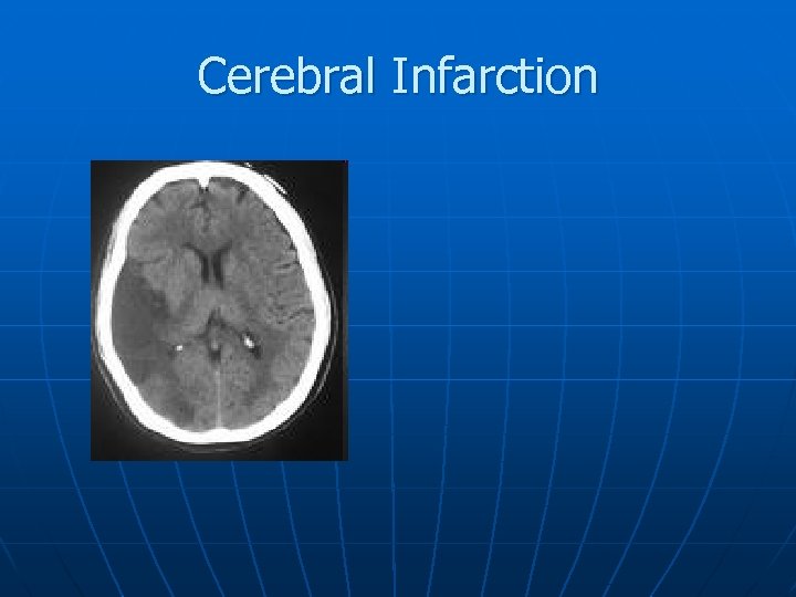 Cerebral Infarction 