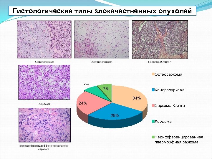 Гистологические типы злокачественных опухолей Остеосаркома 7% 7% Хондросаркома 34% 24% Саркома Юинга 28% Хордома