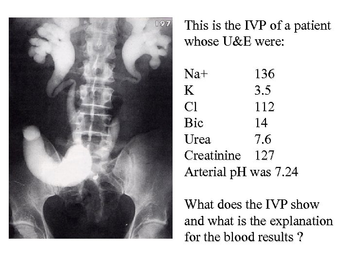 This is the IVP of a patient whose U&E were: Na+ 136 K 3.