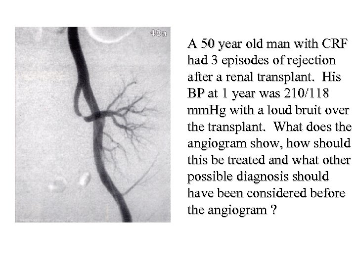 A 50 year old man with CRF had 3 episodes of rejection after a