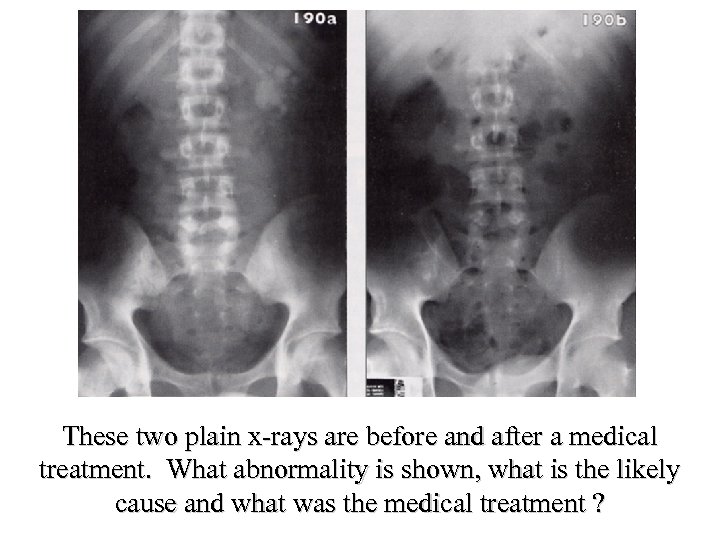 These two plain x-rays are before and after a medical treatment. What abnormality is