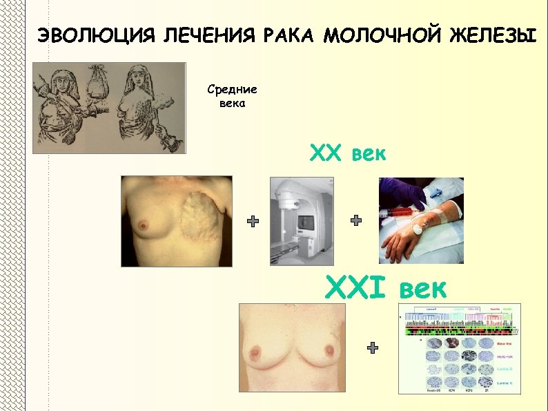 ЭВОЛЮЦИЯ ЛЕЧЕНИЯ РАКА МОЛОЧНОЙ ЖЕЛЕЗЫ Средние века XX век XXI век 