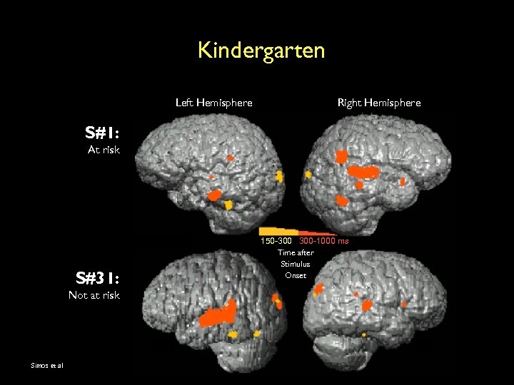 Kindergarten Left Hemisphere Right Hemisphere S#1: At risk S#31: Not at risk Simos et