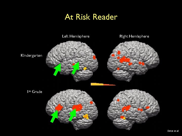 At Risk Reader Left Hemisphere Right Hemisphere Kindergarten 1 st Grade Simos et al