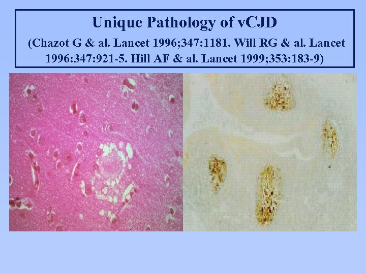 Unique Pathology of v. CJD (Chazot G & al. Lancet 1996; 347: 1181. Will