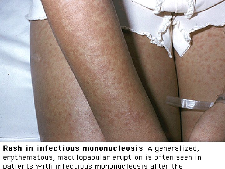 . Of NHL WHO classification 